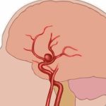 Aneurisma Berry, Ancaman Senyap Pada Pembuluh Darah Otak