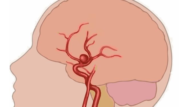 Aneurisma Berry, Ancaman Senyap Pada Pembuluh Darah Otak