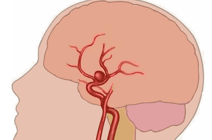 Aneurisma Berry, Ancaman Senyap Pada Pembuluh Darah Otak