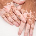 Penyakit Vitiligo Terjadi Karena Sel Pigmen Melanosit Rusak