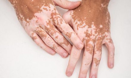 Penyakit Vitiligo Terjadi Karena Sel Pigmen Melanosit Rusak