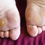 Mata Ikan Terjadi Di Area Kaki, Bagaimana Cara Menghilangkan?