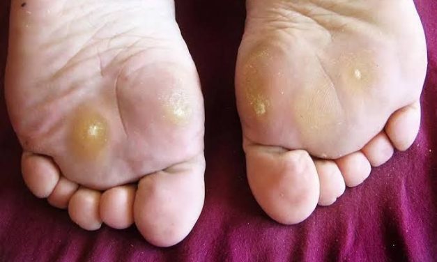 Mata Ikan Terjadi Di Area Kaki, Bagaimana Cara Menghilangkan?