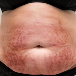Cushing Syndrome, Apakah Anda Mengalaminya? Ini Penyebabnya!