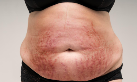 Cushing Syndrome, Apakah Anda Mengalaminya? Ini Penyebabnya!