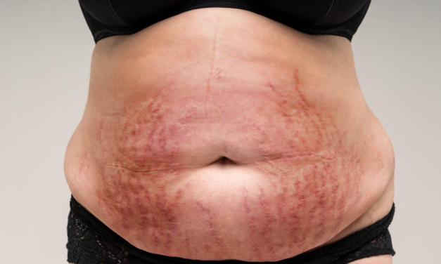Cushing Syndrome, Apakah Anda Mengalaminya? Ini Penyebabnya!