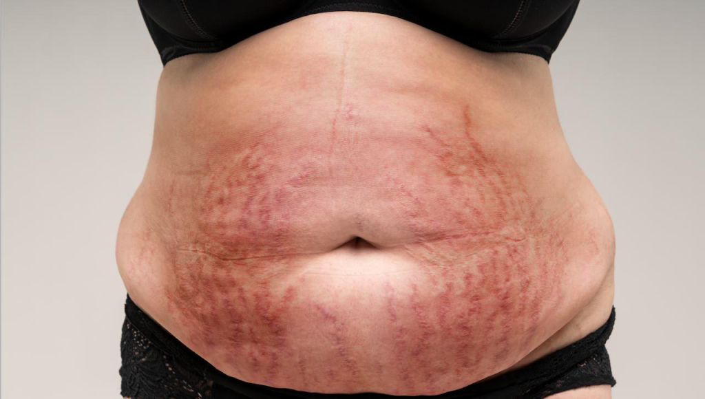 Cushing Syndrome, Apakah Anda Mengalaminya? Ini Penyebabnya!