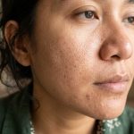 Penumpukan Minyak Wajah Bikin Pori-pori Lebih Besar, Benarkah?