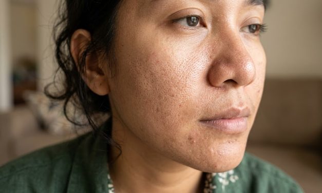 Penumpukan Minyak Wajah Bikin Pori-pori Lebih Besar, Benarkah?