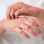 Penyakit Frambusia Suatu Infeksi Kulit, Ini Dia Beberapa Gejalanya