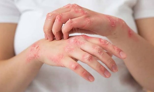 Penyakit Frambusia Suatu Infeksi Kulit, Ini Dia Beberapa Gejalanya